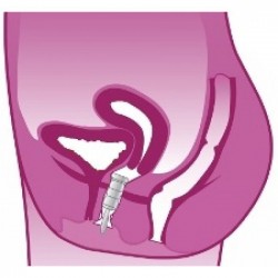 IncoStress - Dispositif pour éviter les fuites urinaires