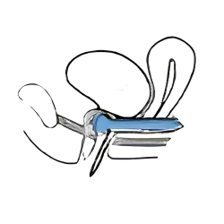 Dr Arabin - Pessario uretrale con bottone DR ARABIN - 3